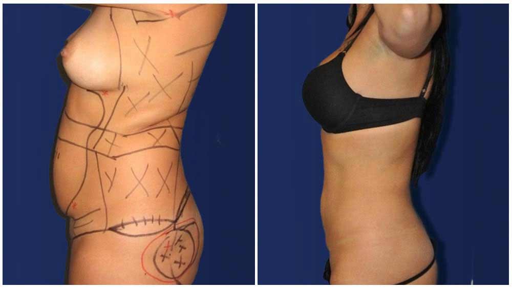 Fat Transfer of a Indianapolis Liposuction Specialty Clinic Female Patient - (30 years)